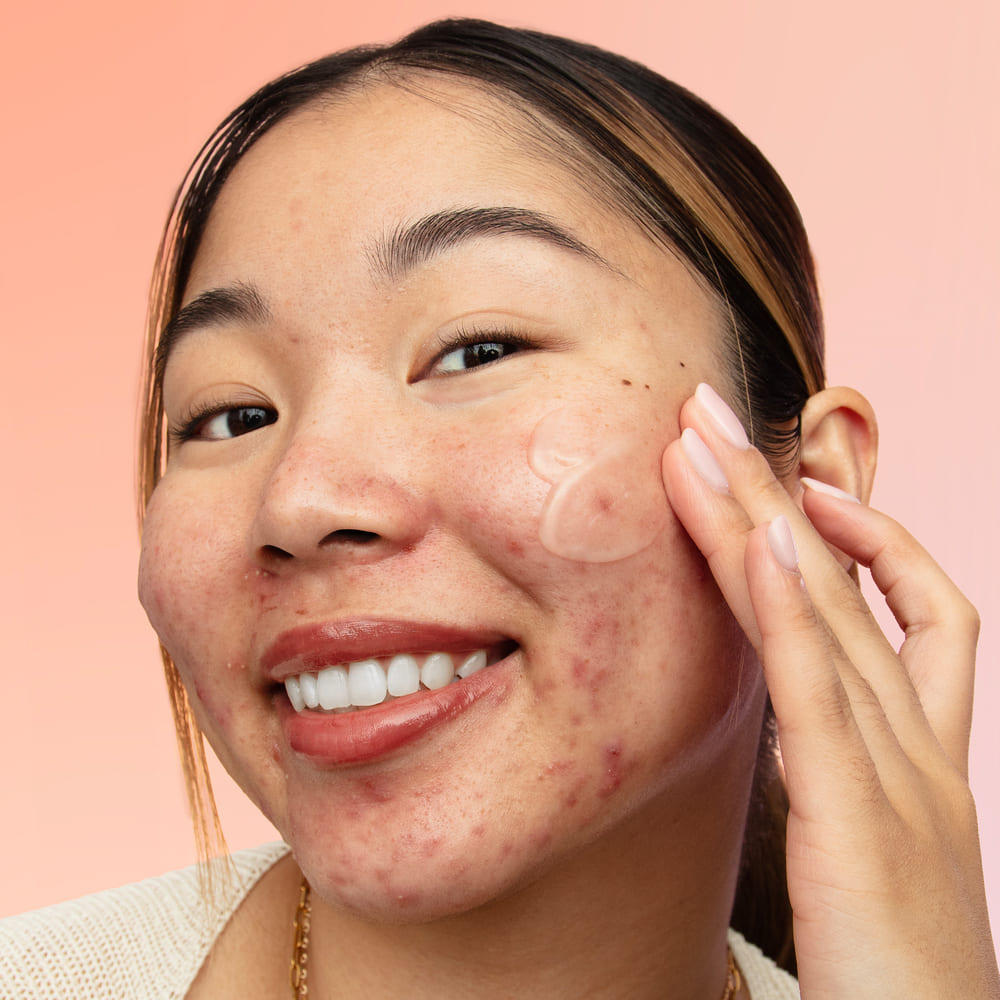 GEL HUMECTANTE PARA EL ACN&Eacute; CON 2 % DE &Aacute;CIDO SALIC&Iacute;LICO (GEL HIDRATANTE)